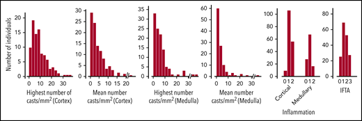 Pathology findings. There was no cortex in 3 biopsy specimens and no medulla in 67 (38%), where no highest or mean number of casts could be determined.