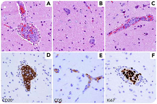 A 58-year-old man presented acutely delirious and confused, initially presumed secondary to alcohol withdrawal. Subsequently, computed tomography imaging showed bilateral areas of encephalomalacia. Brain biopsy revealed preserved brain parenchyma with large mitotically active atypical lymphoid cells occupying numerous blood vessels and capillaries (panels A-C, hematoxylin and eosin, original magnification ×400). Atypical cells outside of the vessels were not seen. The large blastic cells expressed CD20 and CD5 and were highly proliferative by Ki67 staining (panels D-F, original magnification ×400). Additional stains demonstrated non–germinal center immunophenotype and overexpression of MYC and BCL2. The patient was diagnosed with intravascular large B-cell lymphoma (IVLBCL), a lymphoma with exclusively intravascular growth and variable large cell morphology.