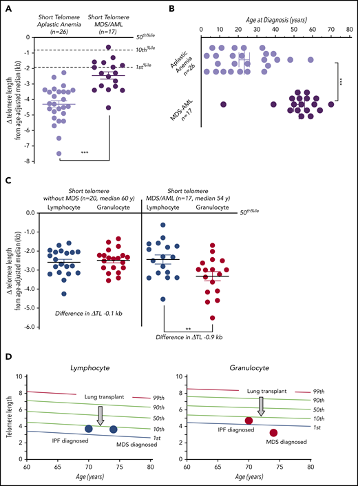 Telomere length discordance in short telomere patients with MDS/AML. (A) Mean of Δ telomere length from age-adjusted median in lymphocytes for patients with aplastic anemia and MDS/AML. (B) Age of diagnosis for patients with aplastic anemia and MDS/AML shows older age of onset for the latter group. (C) The degree of deviation from the age-adjusted median in lymphocytes and granulocytes in short telomere cases without (n = 20; median age, 60 years; range, 45-76 years; 13 male/7 female) and with MDS/AML (n = 17; median age, 54 years; range, 12-74 years; 11 male/6 female). Mean is graphed plus or minus standard error of the mean. **P = .001 (Mann-Whitney U test); ***P < .001 (Wilcoxon rank matched-pair test). (D) Longitudinal lymphocyte and granulocyte telomere lengths for 1 individual obtained at idiopathic pulmonary fibrosis (IPF) diagnosis and 4 years later at MDS diagnosis. The intervening age of lung transplant is graphically annotated by the arrow at age 72.