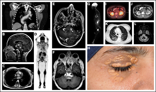 Diverse manifestations of ECD. (A) Coronal postcontrast chest computed tomography (CT) demonstrates extensive soft tissue sheathing of the thoracic aorta. (B) Enhancing lesions in the hypothalamic pituitary axis (HPA), brainstem, and cerebellar peduncle is shown in sagittal gadolinium enhanced T1 magnetic resonance imaging (MRI). (C) Three-dimensional fast imaging using steady-state acquisition (3D-FIESTA) MRI of the heart showing right atrial mass from ECD. (D) Maximal intensity projection (MIP) of 18F-fluoro-deoxyglucose (FDG)–positron emission tomography (PET) demonstrates typical hypermetabolic ECD lesions throughout the appendicular skeleton with greatest activity of the disease in the legs. (E) Irregular bilateral enhancing of ECD lesions in the middle cerebellar peduncles are demonstrated by postgadolinium axial T1 MRI. (F) Expansile irregularly enhancing ECD lesions in the pons seen on postgadolinium axial T1 MRI. (G) MIP of FDG-PET demonstrating ECD lesions with increased uptake in distal femur, orbit, multilevel thoracolumbar spine roots, and right atrium. (H) Periorbital xanthelasmas from ECD. (I-J) “Hairy kidney” hypermetabolic and contrast-enhancing perinephric infiltrates are shown on axial-fused FDG PET-CT and contrast-enhanced axial CT scan. (K) High-resolution axial CT scan image of the chest demonstrating reticulonodular opacities from ECD. (L) Atrophic or neurodegenerative changes in the brainstem and cerebellum are shown by axial T2-FLAIR MRI.