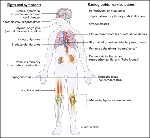Signs/symptoms and radiographic features of ECD. RDD, Rosai-Dorfman-Destombes disease. Used with permission of Mayo Foundation for Medical Education and Research, all rights reserved.