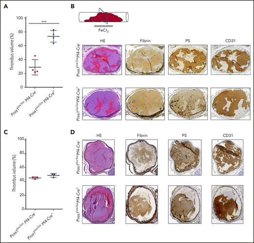 Platelets PS limits thrombosis propensity in the vena cava, but not in the carotid artery. (A) Evaluation of the thrombus volume in the vena cava 30 minutes after the FeCl3 injury, using ultra-high-frequency US (n = 4/genotype). Using the Vevo 3100 imaging system (Fujifilm VisualSonics Canada) and a MX550S linear array transducer (bandwidth, 32-55 MHz; center frequency, 40 MHz), 3-dimensional image series were acquired after 30 minutes of thrombus induction at 76-µm intervals. Using the VevoLab software package (Fujifilm VisualSonics), the 3-dimensional image series were used to make a 3-dimensional reconstruction of the inferior vena cava or carotid artery and a 3-dimensional reconstruction of the thrombus. The vessel and the thrombus area were measured by the software in cubic millimeters. The thrombus volume (%) refers to the volume (in cubic millimeters) that the thrombus occupies inside the volume (mm3) of the vessel. (B) Thrombi collected at the end of the experiment (=30 minutes after the FeCl3 injury) and processed for immunohistochemistry; the sections were performed in the middle of the vena cava thrombus, as shown. Hematoxylin and eosin staining (HE) and immunohistochemistry for insoluble fibrin, PS, and CD31 were realized in Pros1lox/loxPf4Cre− and Pros1lox/loxPf4Cre+ vena cava thrombi 30 minutes after the FeCl3 injury. Scale bar, 500 µm. (C) Evaluation of the thrombus volume in the carotid artery 30 minutes after the FeCl3 injury, using ultrahigh-frequency US (n = 3/genotype). For the method of evaluation of the thrombus volume, see panel A. (D) HE and immunohistochemistry for insoluble fibrin, PS, and CD31 were realized in Pros1lox/loxPf4Cre− and Pros1lox/loxPf4Cre+ carotid artery thrombi 30 minutes after the FeCl3 injury. Scale bar, 200 µm.