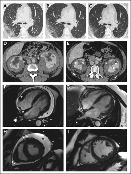 Organ responses. (A-C) Chest high-resolution CT scans in patient 12 show progressive regression of ECD-related lung disease (the scans were taken respectively before treatment and at months 6 and 12 after the beginning of therapy with everolimus) (axial view). (D-E) Contrast-enhanced abdominal CT scans in patient 8 show marked regression of perirenal infiltration with consequent improvement of hydronephrosis and calycectasia (axial view). (F-I) Cardiac magnetic resonance (cine frame from steady-state free precession sequence) in a patient (#19) with cardiac involvement; the scans were taken at baseline (F,H) and after 1 year of treatment (G,I). (F) Circumferential pericardial effusion (black star) and pathologic soft tissue in the right atrioventricular groove and the right side of the interatrial septum (white stars). Arrows (H) indicate nodular thickening of the visceral pericardium. Pericardial effusion and infiltrative lesions almost completely disappeared (G,I; scans after treatment).