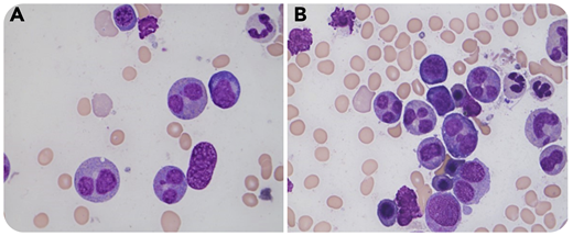 A 42-year-old woman with relapsed acute myeloid leukemia with an isocitrate dehydrogenase 2 mutation achieved clinical remission on triple therapy with venetoclax, decitabine, and enasidenib for 4 weeks while awaiting an allogeneic stem cell transplantation. Bone marrow biopsy demonstrated normocellular marrow with no evidence of residual disease by morphologic, immunophenotypic, and cytogenetic evaluation or by minimal residual disease evaluation. However, striking abnormal morphologic alternations exclusively restricted to marrow granulocytic precursors were seen in the marrow aspirate, appearing as prominent bilobed to trilobed nuclei (panels A-B; Wright-Giemsa stain, original magnification ×1000), which were round, oval, peanut/coffee bean–shaped, symmetric, or asymmetric with abnormally clumped chromatin, mimicking the so-called Pelger-Huët anomaly in circulation. Approximately 50% to 60% of marrow granulocytic precursors demonstrated this morphologic alteration, and no similar nuclear changes were appreciated in megakaryocytic or erythroid precursors. Review of the patient’s bone marrow and blood smears prior to the current therapy as well as review of concurrent blood smears failed to demonstrate similar findings.