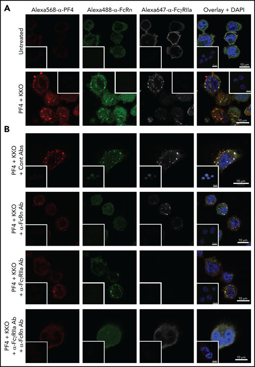 Colocalization of HIT ICs, FcRn, and FcγRIIa on THP-1 cells upon treatment with IgG-containing ICs. (A) THP-1 cells immobilized on RetroNectin were left untreated (top) or incubated with PF4 + KKO complexes (bottom) for 15 minutes as in Figure 1A, washed, and fixed in 4% paraformaldehyde in PBS. (B) Inhibition of HIT ICs binding and coclustering with FcRn and FcγRIIa by α-FcRn and α-FcγRIIa mAbs on the surface of THP-1 cells. THP-1 cells were preincubated with control human IgG4 and control mouse IgG (TRA; 200 μg/mL both; top), α-FcRn antibody (Ab; 200 μg/mL of SYNT001; second row) or with α-FcγRIIa Ab (200 μg/mL IV.3; third row) or with both Abs (bottom) for 30 minutes before addition of PF4 and KKO ICs for 15 minutes. The cells were then washed, fixed, and stained. PF4/KKO ICs, FcRn, and FcγRIIa were detected using Alexa-568–conjugated α-PF4/heparin mAb KKO (red), Alexa-488–conjugated α-human FcRn mAbs (green), and Alexa-647–conjugated FcγRIIa mAbs (pseudocolored in white). Nuclei were counterstained with 4′,6-diamidino-2-phenylindole (DAPI; blue). Individual red, green, and deep-red channels and their overlays with blue channel (nuclei staining; overlay + DAPI) are shown. Staining with negative control Abs is shown within the insets in each panel. Scale bars, 10 μm.