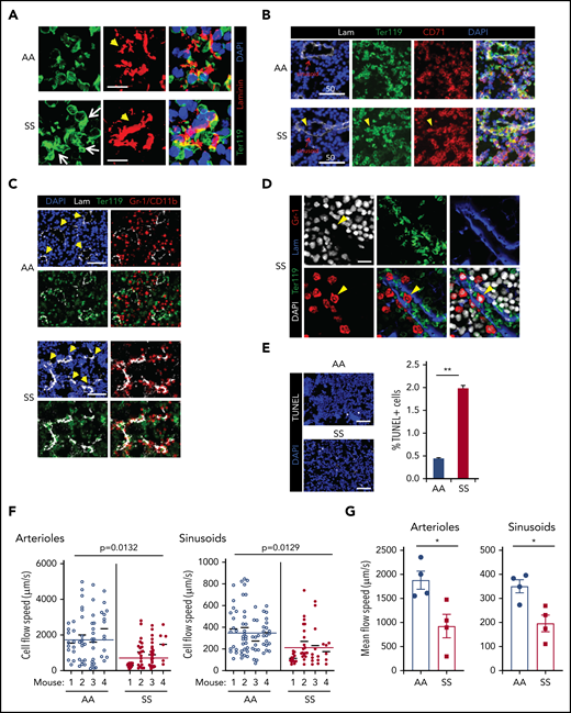 In situ generation of RBC aggregates, slow blood cell flow speed, and increased cell apoptosis are pathologic features of SCD BM. (A) Thirteen- to 15-week-old AA or SS mice were subjected to transcardial perfusion with phosphate-buffered saline, immediately after being euthanized with CO2, to flush nonadherent RBCs in the vasculatures, followed by fixation. Frozen thin sections (5 μm thickness) of SCD mouse femurs were stained with antibodies against Ter119 and laminin, followed by DAPI staining. Confocal microscopy (Leica SP8X) images were processed to show Ter119+ erythrocyte aggregates. Arrows indicate intra- and peri-sinusoidal sickle RBC aggregates. Arrowheads indicate sinusoids identified by vascular marker laminin. Scale bars, 10 μm. (B) Rabbit antibody against CD71 (transferrin receptor) was used to identify immature erythroid cells (Ter119+ CD71+ DAPI+) in confocal analysis (Leica SP8X) after immunofluorescence staining of frozen sections (5 μm thickness) of SCD mouse femurs. Arrowheads indicate aggregates of immature sickle RBC in sinusoids. Scale bars, 50 μm. (C) Gr-1/CD11b+ myeloid cells aggregated with sickle RBCs perisinusoidally in the femoral BM sections of SCD mice were analyzed by LaSC. Arrowheads denote sinusoids. Scale bars, 50 μm. (D) Gr-1+ cells, aggregated with sickle RBCs intrasinusoidally in frozen sections (5 μm thickness) of femoral BM of SCD mice, were analyzed by confocal microscopy (Leica SP8X). Arrowheads denote an intrasinusoidal Gr-1+ myeloid cell. Scale bar, 20 μm. (E) Frozen sections of femurs were stained with a Click-It Plus TUNEL Assay (Life Technologies). TUNEL+ apoptotic cells and DAPI+ BM cells were quantitated by LaSC. Bar graphs are plotted as mean + standard error of the mean (SEM); n = 4 mice per group (13-15 weeks old; 2 female and 2 male mice). Scale bars, 50 μm. **P < .01, Student t test. (F and G) For the flow speed measurement, Rhodamine B-dextran (70 kDa) was injected retro-orbitally, followed by calvarial vasculature recording using confocal intravital microscopy and calculation of endogenous blood cell flow speed (displacement over time) by negative contrast approach using ImageJ, as described previously (see also supplemental Figure 2A).80,81 (F) Flow speed value per cell was plotted as scatter dot plots for each individual mouse, with a mean of individual mouse and pooled total shown as thinner and wider horizontal lines, respectively, by Prism 8 software (GraphPad). Each circle represents an individual RBC. The numbers of cells plotted from each mouse (total 4 mice) were 14, 18, 19, 13 (AA)/ 21, 20, 29, 6 (SS) for arterioles and 15, 26, 13, 19 (AA)/ 14, 19, 11, 6 (SS) for sinusoids. The P values were analyzed by a generalized linear model with a random effect of mouse nested within genotype (n = 4 mice). (G) The average RBC flow speed of each mouse was calculated as 1 data point and represented as dots. Bar graphs depict the mean of mean flow speeds of individual mouse as mean + SEM, n = 4 mice (12-15 weeks old; 2 female mice and 2 male mice). *P < .05, Student t test with Bonferroni correction for multiple comparisons.