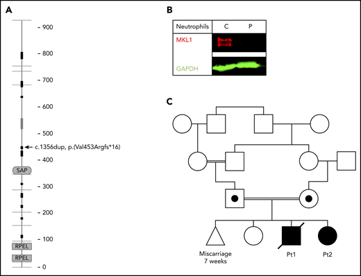 MKL1 mutation and family pedigree. (A) MKL1 protein structure; the location of the homozygous frameshift mutation leading to a premature stop codon is indicated (arrow) (adapted from SMART,68 with permission). (B) Absence of MKL1 in the patient’s neutrophils was confirmed by western blotting. GAPDH was used as loading control. (C) Pedigree of the family carrying the MKL1 mutation. Double lines indicate consanguinity; circle indicates female; square indicates male; triangle indicates miscarriage; diagonal through symbol indicates deceased; black symbols indicate clinically affected homozygous individual; black dot in symbol indicates clinically unaffected heterozygous individual. C, control; GAPDH, glyceraldehyde-3-phosphate dehydrogenase; P, patient.