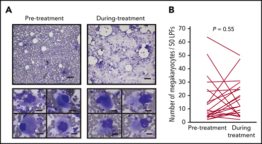 IMiD therapy spares megakaryocytes in the bone marrow. (A) Bone marrow aspirates before and during treatment from case 1 listed in Table 1 (May-Giemsa staining). Lower panels show representative megakaryocytes. Images were captured by a BH-2 microscope (Olympus) and ACT-2U imaging software (Nikon) with ×100 (upper; scale bar, 100 µm) and ×400 (lower; scale bar, 25 µm) magnification. (B) Number of megakaryocytes per 50 low-power fields (LPFs) in bone marrow aspirates from 24 patients listed in Table 1. Each line represents the change in the number of megakaryocytes in each patient. P value was determined by 2-tailed Student t test. To avoid the potential influence of tumor infiltration on hematopoiesis, bone marrow samples with <10% clonal plasma cells were examined.