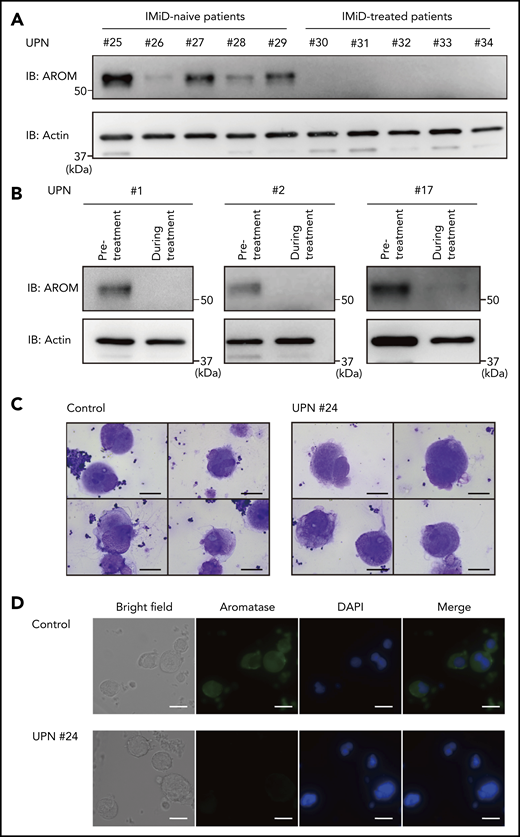 Aromatase is decreased in the bone marrow of IMiD-treated patients. (A) Immunoblot analysis of aromatase (AROM) in bone marrow samples from the cases listed in Table 2. (B) Serial changes in AROM protein levels in the bone marrow samples from cases 1, 2, and 17 listed in Table 1. Frozen viable patient samples were thawed at 37°C. The cells were lysed in RIPA lysis buffer. Immunoblot analysis was performed using 5 to 10 µg of protein per sample. Because of limited availability of the patient samples, the experiment was performed only once. (C) Cytospin preparations of megakaryocytes isolated from bone marrow samples of a healthy volunteer and case 24 listed in Table 1 (May-Giemsa staining). Images were captured by a BH-2 microscope (Olympus) and ACT-2U imaging software (Nikon) with ×600 magnification (scale bars, 25 µm). (D) Representative immunofluorescence microscopic images of megakaryocytes. Cells were stained with anti-AROM antibody (green). Nuclei were counterstained with 4′,6-diamidino-2-phenylindole (DAPI) (blue). Megakaryocytes were identified as large cells containing a multilobulated nucleus. Images were captured by BZ-X700 (Keyence) with ×40 objective lens (scale bars, 25 µm). Two independent patient-control–matched pair experiments were performed. UPN, unique patient number.