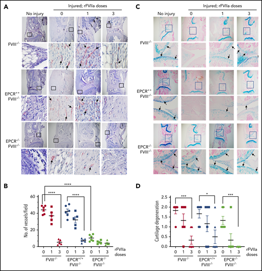 Evaluation of neoangiogenesis and cartilage degeneration in knee joints of FVIII−/− , EPCR++ FVIII−/− , and EPCR−/− FVIII−/− mice 2 weeks after needle puncture–induced joint bleeding. Joint bleeding in FVIII−/−, EPCR++FVIII−/−, and EPCR−/−FVIII−/− mice was induced by needle puncture of joints, and the mice were treated with a single dose or 3 doses of rFVIIa or left untreated as described in the Figure 1 legend. Fourteen days after injury, knee joints were excised, sectioned, and tissue sections were immunostained with the endothelial cell–specific marker CD31 (A) or Alcian blue for proteoglycans (C). As a control, knee joint tissue sections of uninjured mice were also stained. The original magnification of images shown in the top lane is ×4. The area identified in the square box was reimaged at higher magnification (×40) and shown in the bottom lane. Arrows point out newly formed blood vessels (A) and articular cartilage (C). (B) To quantify neoangiogenesis, the number of blood vessels positively stained with CD 31 was counted in multiple fields and averaged per field. (D) Cartilage degeneration was scored on a 0 to 2 scale (0, absence of cartilage degeneration; 1, partial loss of proteoglycan content and pannus formation; 2, complete cartilage degeneration/absence of proteoglycans, pannus formation, and femur remodeling). *P < .05; ***P < .001; ****P < .0001.