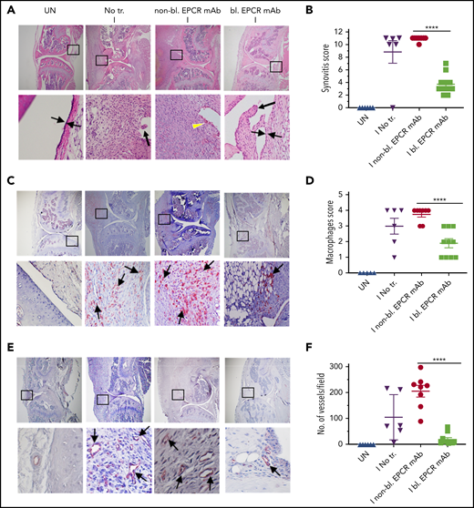 EPCR blocking reduces the severity of hemophilic synovitis following hemarthrosis in FVIII−/− mice. FVIII−/− mice were administered with EPCR-blocking mAb (bl. EPCR mAb), EPCR-nonblocking mAb (non-bl. EPCR mAb), or no mAb (No tr.). Twenty-four hours later, joint bleeding was induced with a needle puncture (I). UN indicates an uninjured knee. Two weeks after the injury, mice were killed, knee joints were excised, and joint tissue sections were processed for histopathological analysis by staining with H&E (A), macrophage marker F4/80 (C), and CD31 antibody to identify blood vessels (E). The red staining (C,E) indicates macrophages and blood vessels, respectively. (A) Two thin black arrows pointing each other indicate width of synovial lining layer, the yellow arrowhead points out red blood cells, and thick black arrows point out synovial villi. Arrows point out macrophages (C) and blood vessels (E). (B) Synovitis score. (D) Macrophage scoring. (F) Number of blood vessels counted per field. Shown are representative images, and data in bar graphs are mean ± SEM (n = 5 to 10 mice/group). ****P < .0001.