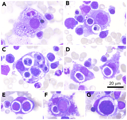 A previously healthy 55-year-old woman presented with fever, malaise, and a mild cough. Chest radiograph revealed bilateral patchy infiltrates. A nasopharyngeal swab tested positive for severe acute respiratory syndrome coronavirus 2 (SARS-CoV-2) RNA. Progressive respiratory insufficiency necessitated intubation on admission day 3. She developed profound normocytic anemia (hemoglobin, 6.8 g/dL) and thrombocytopenia (23 × 103/µL) that were refractory to platelet and erythrocyte transfusions. Ferritin levels increased sharply, peaking at admission day 8 (19 558 ng/mL). Bone marrow examination revealed striking hemophagocytosis and erythroid hyperplasia. Hemophagocytosis refers to the pathologic finding of macrophage engulfment of host blood cells (panel A, engulfment of a granulocyte; panels B-F, engulfment of various erythroid precursors; panel G, engulfment of a megakaryocyte nucleus; all panels, original magnification ×100, May-Grünwald-Giemsa stain). There was no evidence of bacterial infection or hematological malignancy. The ensemble of bicytopenia, extreme hyperferritinemia, and hemophagocytosis, unexplained by other causes, yields a likely diagnosis of reactive hemophagocytic lymphohistiocytosis. Hydroxychloroquine was discontinued after cardiac arrhythmia provoked by severe pulmonary embolism. The clinical course was protracted; transfusion dependency abated, and the patient recovered after 45 days of ventilator dependency and supportive care.