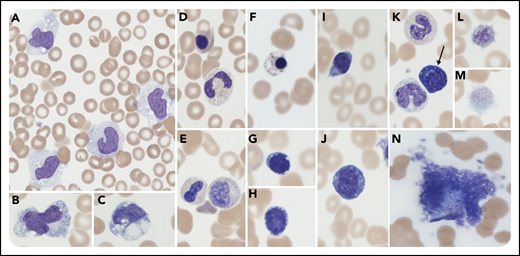 An 81-year-old man presented with shortness of breath, fever, hypoxia, and widespread diffuse infiltrates on a chest radiograph. Oral swab testing was positive for severe acute respiratory syndrome coronavirus 2 (SARS-CoV-2; RNA reverse transcriptase–polymerase chain reaction RdRp gene). Despite therapy with oxygen and antibiotics, the patient deteriorated and required ventilator support. Comorbidities included hypertension, chronic renal disease, and restrictive lung disease. A blood film was prepared upon transfer to intensive care, 48 hours prior to death. Laboratory parameters at that time were: hemoglobin, 90 g/L; neutrophils, 2.78 × 109/L; lymphocytes, 1.06 × 109/L; monocytes, 2.5 × 109/L; and platelets, 44 × 109/L. Inflammatory markers linked to poor outcome rose during the admission with C-reactive protein reaching 406 mg/L and troponin reaching 1852 ng/L. The blood film (panels A-N; original magnification ×1000 for all panels; May-Grünwald–Giemsa stain) revealed: increased pleomorphic (panel A) and vacuolated monocytes (panels B-C); leukoerythroblastic features (panels D-E); nucleated red cells with dyserythropoiesis/basophilic stippling (panel F); lymphopenia, some with cytoplasmic vacuolation (panels G-H); lymphoplasmacytoid lymphocytes (panels I-J); an occasional plasma cell (panel K arrow); thrombocytopenia, giant platelets (panels L-M); and a circulating megakaryocyte (panel N).