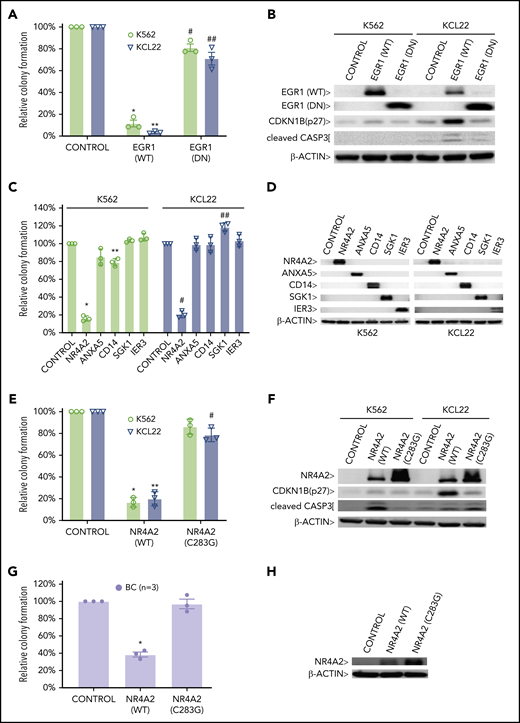 PRC1 contributes to BC by inhibiting expression of BC tumor suppressors. CFAs of K562 and KCL22 cells retrovirally transduced with (A) EGR1, either wild-type (WT) or dominant negative (DN) or (C) the indicated cDNAs are shown. (A) *P = .001; **P = .00004; #P = .03; ##P = .04. (C) *P = .000001; **P = .0011; #P = .000003; ##P = .003. CFAs of K562, KCL22 (E), and primary BC cells (G) retrovirally transduced with FLAG-NR4A2, either wild-type (WT) or (C283G) mutant are shown. (E) *P = .0009; **P = .0022; #P = .027. (G) *P = .0021. For panels A, C, E, and G, results are given as mean ± standard deviation (n = 3). For each CFA plot, the corresponding immunoblots are shown on the right (B,D,F,H). Control, cells retrovirally transduced with empty vector.