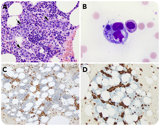 The patient is a 66-year-old Middle Eastern woman who presented with B symptoms (severe fatigue, night sweats, and fever), weight loss, anemia, and splenomegaly with elevated liver enzymes and respiratory insufficiency. Bone marrow biopsy showed a B-lymphocyte population with pleomorphic nuclei and prominent nucleoli that expanded the bone marrow sinusoids (panel A, hematoxylin and eosin stain, 40× objective, original magnification ×400) and was highlighted by PAX5 (panel C, PAX5 immunohistochemical study, 20× objective, original magnification ×200) and CD20 (panel D, CD20 immunohistochemical study, 20× objective, original magnification ×200). Hemophagocytosis was present (panel B, Wright-Giemsa stain, 60× objective, original magnification ×600). Immunohistochemical studies showed the lymphoma cells to be positive for CD20, PAX5, CD5, BCL2, BCL6 (dim), MUM1, and LEF1 and negative for CD10, SOX11, c-MYC, and PD-L1. No other tissue biopsy was performed.