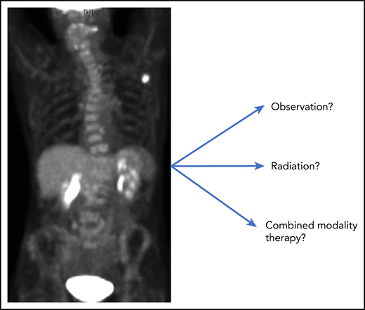 Treatment choices for early-stage NLPHL.