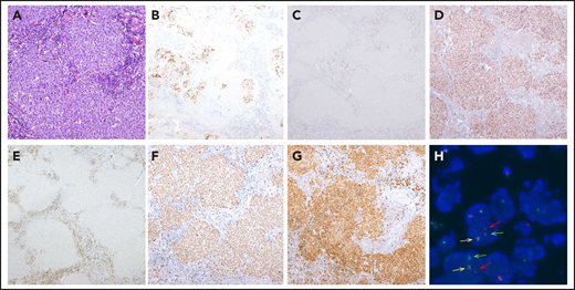 Morphological, immunophenotypic, and genetic features of a LBCL with IRF4 rearrangement (case D62). Architecture effacement by an atypical lymphoid proliferation with nodular growth pattern (A; hematoxylin and eosin) that corresponds to expanded follicles with highly disrupted follicular dendritic cell meshwork (B; CD21). The atypical cells were negative for CD10 (C) and positive for BCL6 (D). BCL2 was positive in the accompanying reactive T cells but negative in the tumor (E), which exhibits a high proliferation rate (F; Ki67). The immunohistochemical study for IRF4/MUM1 (G; MUM1) shows strong and diffuse positivity in the neoplastic proliferation, and FISH with IRF4 break-apart probe shows a signal constellation of 1 colocalization (yellow arrow) and 1 split signal (red and green arrows) consistent with the gene rearrangement (H). Original magnification ×100 (A), ×40 (B-G).