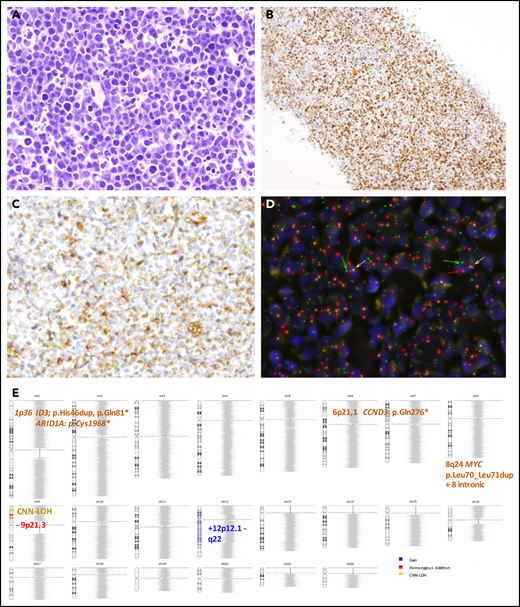Morphological, immunophenotypic and genetic features of an HGBCL, NOS with MYC rearrangement (Case D59). Hematoxylin and eosin stain (A) depicting mild heterogeneity with certain cellular irregularity of the neoplastic cells that are BCL6 positive (B) with partial expression of BCL2 (C). (D) FISH with MYC break-apart shows a signal constellation of 1 colocalization (yellow arrow) and 1 split signal (green and red arrows). (E) Ideogram of the CN, CNN-LOH, and mutational features of this case. Original magnification ×400 (A,C), ×100 (B).