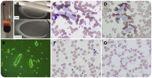 A 66-year-old man presented with a 5-year history of lower-limb livedo reticularis. Complete blood count demonstrated: hemoglobin, 108 g/L; leukocytes, 9.46 × 109/L; and platelets, 393 × 109/L; increased large unstained cells were noted on automated differential. His plasma showed gel-like precipitation (panel A). His blood smear showed visible fine-grained agglutinates compared with control (panel B). Wright-Giemsa staining (panels C, D, F, G) demonstrated multiple extracellular cylindrical crystals (panel C; original magnification ×1000) that partially resolved with warming to 37°C for 30 minutes (panel D; original magnification ×1000). Variable sizes of cylindrical and irregular crystals were observed by phase-contrast microscopy after lysing red blood cells (RBCs) (panel E; original magnification ×400). However, when the patient’s sample was delivered at 37°C and tested immediately, only scattered amorphous particles were observed (panel F; original magnification ×1000), which aggregated at room temperature after 30 minutes and induced RBC morphologic changes mimicking schistocytes and helmet cells (panel G; original magnification ×1000) without actual hemolysis (indirect bilirubin, 3.3 μmol/L; lactate dehydrogenase, 382 U/L). Cryoglobulin testing showed monoclonal immunoglobulin G λ (13091.5 mg/L). Bone marrow examination revealed 15.5% myeloma cells, and multiple myeloma with type 1 cryoglobulinemia was diagnosed.