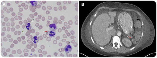 A 27-year-old female with autoimmune polyendocrinopathy-candidiasis-ectodermal dystrophy (APECED) caused by autoimmune regulator (AIRE) gene mutations, was hospitalized at the National Institutes of Health for routine follow-up of autoimmune pneumonitis. She acutely developed fever (39.9°C), tachycardia (126 beats/minute), and hypotension (58/25 mm Hg) requiring fluid resuscitation and vasopressor support. Laboratory studies revealed leukocytosis (66.4 × 109/L), left shift, metabolic acidosis (pH 7.18), acute renal failure, and shock liver (alanine aminotransferase, 1927 U/L). Peripheral blood smear (panel A; Wright's stain, objective 100×, original magnification ×1000) showed neutrophil toxic granulation (75%; red arrow) consistent with septicemia and Howell-Jolly bodies (2%; black arrow) and echinocytes (14.5%; green arrow) consistent with asplenia. Abdominal computed tomography (panel B) revealed an atrophic spleen. Blood cultures grew Streptococcus pneumoniae, which accounts for ∼50% of septicemia cases in asplenic patients. The patient fully recovered, received vaccination against pneumococcus and other encapsulated microorganisms, and was started on azithromycin prophylaxis due to a prior severe penicillin allergy.