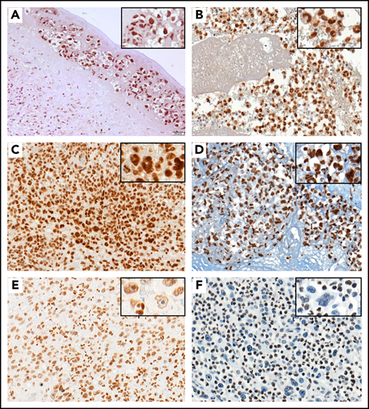 pSTAT3 and H3K4me3 immunostaining in BI-ALCL. Representative STAT3 wild-type (A) and STAT3-mutated (B) BI-ALCL cases showing nuclear expression of phospho-STAT3 in tumor cells regardless of the mutational status (A, hematoxylin and eosin stain, original magnification ×200; B, hematoxylin and eosin stain, original magnification ×200). Representative cases of KMT2C/2D wild-type BI-ALCLs showing strong nuclear expression of H3K4me3 (C, original magnification ×400) and H3K4me1 (D, original magnification ×400) with similar intensities in lymphoma cells and reactive surrounding cells. By contrast, the nuclear H3K4me3 staining in a representative case of KMT2C mutated BI-ALCL was weaker in tumoral cells than in reactive cells such as neutrophils (E, original magnification ×200). Similarly, nuclear H3K4me1 staining was lost in most neoplastic cells of a KMT2D-mutated BI-ALCL case (F, original magnification ×200).