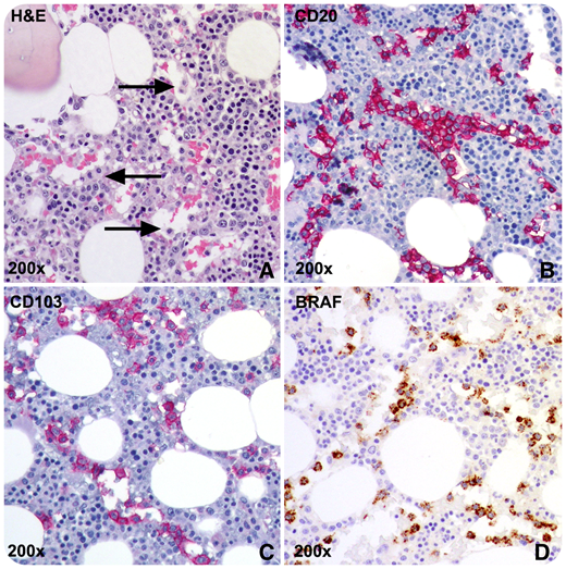 A 37-year-old man presented to our clinic with persistent fatigue and dyspnea on exertion after receiving cladribine treatment 6 months earlier for hairy cell leukemia (HCL), diagnosed in another hospital. Complete blood count was normal, and splenomegaly was absent. Bone marrow (BM) examination, to reassess disease status, revealed a population of large-sized lymphocytes, with abundant cytoplasm and oval nuclei (panel A, black arrows), with an unexpected intrasinusoidal pattern of infiltration, positive for CD20 (panel B), CD103 (panel C), DBA44/CD72, CD25, CD11c, Cyclin-D1, and Annexina-A1 at immunohistochemical essay, accounting for ∼15% of BM cellularity. Reticulin fibrosis was grade 1. Immunostaining for mutated BRAF protein (panel D) confirmed the diagnosis of HCL persistence; BRAF V600E mutation was detected on BM blood sample.