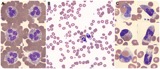 A 54-year-old man was admitted to the hospital with a 4-day history of progressive chills, lower-extremity myalgias, jaundice, and black urine. He had no significant medical history. Initial blood work showed hemoglobin level of 9.9 g/dL (reference range, 13.9-16.3 g/dL), total bilirubin of 7.7 mg/dL (reference range, 0.2-1.2 mg/dL), lactate dehydrogenase of 2204 U/L (reference range, 100-190 U/L), and ferritin of 41 291 ng/mL (reference range, 30-400 ng/mL). Review of the blood smear (Wright-Giemsa stain) showed neutrophil erythrocyte rosettes (panel A), erythrocyte couplets without overt agglutination (panel B), and active neutrophil erythrophagocytosis (panel C). Twelve hours postadmission, hemoglobin level fell to 7.0 g/dL; the patient received a transfusion, and methylprednisolone was initiated. During his admission, the patient continued to demonstrate active hemolysis, requiring transfusion of a total of 7 units of packed red blood cells. Direct antiglobulin test was positive for C3 and negative for immunoglobulin G. Cold agglutinin screen was negative. Donath-Landsteiner testing was positive for biphasic hemolysin, with hemolysis occurring at 37°C after incubation at 4°C, confirming the diagnosis of paroxysmal cold hemoglobinuria. An extensive infectious workup was negative, including for syphilis. On hospital day 6, the patient began to show signs of improvement, with decreasing lactate dehydrogenase, increasing hemoglobin, and downtrend in ferritin.