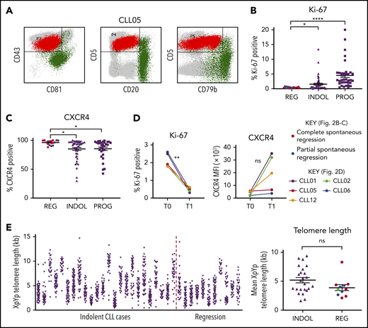 Spontaneously regressed CLL tumors are composed of a nonproliferating CLL clone that has previously undergone substantial cell division. (A) A CD19 gate was applied to the peripheral blood mononuclear cells (PBMCs) to select for CD19+ B lymphocytes (not shown). The CLL population (shown in red) could be distinguished from the nonmalignant B-lymphocyte population (shown in green) by their immunophenotype, as demonstrated by the example of CLL05. CLL cells exhibit high CD5 and CD43 but low CD20, CD79b, and CD81 expression, whereas nonmalignant B lymphocytes exhibit high CD20, CD79b, and/or CD81 expression. This methodology was used to determine the proportion of CLL cells within the B-lymphocyte population, the results of which are displayed in Table 2. (B-C) The gated CLL population of PBMCs was analyzed for the expression of Ki-67 and CXCR4. For each comparison, 17 spontaneous regression cases (REG) from the regression time point (T1) were compared against 54 indolent (INDOL) and 40 progressive (PROG) cases. Complete and partial spontaneous regression cases are represented by red and blue dots, respectively, as shown. Statistical significance was determined using 1-way analysis of variance (ANOVA) with Bonferroni post hoc analysis for cohort comparison and the 2-tailed paired Student t test for time point comparison. Statistical significance is indicated by *P < .05, **P < .01, and ****P < .0001. (D) Expression of Ki-67 and CXCR4 was compared between 2 sequential time points in individual spontaneous regression cases. T0 and T1 represent the diagnostic and the regression time point, respectively. Each colored line represents a specific case as indicated. (E) XpYp single-telomere length analysis was performed on sorted CD19+CD5+ CLLs to assess the telomere length of chromosomes Xp and Yp of CLL cells. Left panel, The telomere length distribution of the CD19+CD5+ sorted CLL Xp and Yp chromosomes in each case. Right panel, The mean CLL XpYp telomere length was compared between spontaneously regressed and indolent cases. Complete and partial spontaneous regression cases are represented by red and blue dots, respectively, as shown. Statistical significance was determined using the Student t test. ns, comparisons that are not statistically significant.