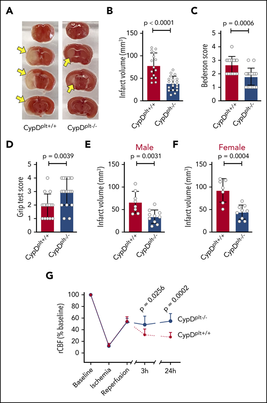 Deletion of platelet CypD reduces infarct size and improves neurologic and motor functions and blood flow following cerebral ischemia-reperfusion injury. Male and female platelet-specific CypD-deficient (CypDplt−/−) mice or littermate controls (CypDplt+/+) were subjected to transient (eg, 1 hour) cerebral ischemia, followed by 23 hours of reperfusion via tMCAO. (A) Representative brain sections stained with 2,3,5-triphenyl tetrazolium chloride. Healthy tissue stains red, whereas an absence of staining (white; arrows) indicates infarcted areas. (B) Brain infarct volumes were quantified by planimetric analysis. (C) Neurological outcome was assessed using the Bederson test; a lower score indicates better functioning. (D) Motor function was examined using the grip strength test; a higher score indicates better functioning. Brain infarct volumes in male (E) and female (F) mice 24 hours after tMCAO. (G) CBF was monitored longitudinally in the right MCA territory (the same side as occlusion) before ischemia (baseline), during ischemia, at the start of reperfusion, and at 3 and 24 hours after stroke onset.