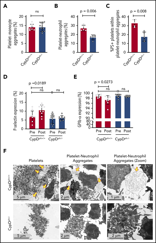 Cerebral ischemia-reperfusion injury induces the formation of circulating necrotic PNAs. Male and female CypDplt−/− mice or littermate controls (CypDplt+/+) were subjected to 1 hour of cerebral ischemia, followed by 23 hours of reperfusion via tMCAO. Twenty-four hours after tMCAO, PMAs (A), PNAs (B), and PS+ platelets within PNAs (C) were quantified by flow cytometry. P-selectin (D) and GPIb-α (E) expression on platelets was analyzed by flow cytometry immediately before and 24 hours after ischemic stroke. (F) Platelets and neutrophils were isolated from CypDplt+/+ and CypDplt−/− mice and activated with dual agonists against PAR4 and GPVI to induce platelet necrosis. PNAs were then imaged by TEM (panels are representative of n = 3 mice per group). Yellow arrows indicate necrotic platelets. ns, not significant.