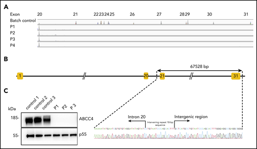 The null allele of the ABCC4 gene is responsible for the PEL-negative phenotype. (A) Integrative Genomics Viewer analysis reveals homozygous loss of exons from 21 to 31 of the ABCC4 gene in 4 PEL-negative individuals (P1, P2, P3, and P4). (B) Schematic representation of the deletion in the ABCC4 gene and Sanger sequencing confirmation of the 67528-pb deletion/18-bp insertion in genomic DNA of PEL-negative individuals. (C) Western blot analyses of ABCC4 in the RBC membranes from PEL-positive (controls 1, 2, and 3) and PEL-negative (P1, P2, and P3) individuals. Immunoblotting was performed with a mouse monoclonal antibody directed against ABCC4. The p55 antibody was used as a loading control.