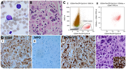 A 78-year-old man with a diagnosis 1 month ago of asymptomatic treatment-naive chronic myeloid leukemia (CML) presented with back pain and dyspnea. Peripheral blood revealed a white blood cell count of 23.8 × 109/L (neutrophils, 22.8 × 109/L; basophils, 0.0 × 109/L; lymphocytes, 0.8 × 109/L), hemoglobin count of 68 g/L, and platelet count of 6 × 109/L, with scattered large mononuclear cells with open chromatin, prominent nucleoli, and deep basophilic cytoplasm with cytoplasmic blebs (panel A; original magnification ×100, May-Grünwald-Giemsa stain). The marrow aspirate was hemodilute; trephine biopsy showed hypercellularity with extensive fibrosis and sheets of blasts (panel B; original magnification ×60, hematoxylin and eosin stain). Flow cytometry (panel Ci-ii) and immunohistochemistry (panels Di-Diii; original magnification ×40) showed that these blasts were positive for CD45 (dim), CD34, CD33, CD42a, CD61, and factor VIII and negative for myeloperoxidase. In addition, a biopsy of a lytic lesion of the ilium bone revealed sheets of large blasts (panel E; original magnification ×40) that were positive for CD34 (panel E inset, original magnification ×40) and CD45 (dim), consistent with a myelosarcoma. Cytogenetics revealed t(9;22) and a complex karyotype. Next-generation sequencing detected TP53 mutation only. A diagnosis of CML in megakaryoblastic crisis was rendered, and the patient succumbed to his illness 9 days later.