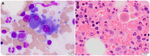 A 59-year-old man had an incidental finding of 0.8 g/dL immunoglobulin G (IgG) gamma monoclonal protein during an evaluation for Crohn’s disease. A bone marrow biopsy showed 5% plasma cells, and an observational approach was taken. Three years later, his M-protein level increased to 3.1 g/dL, and a repeat bone marrow biopsy showed progression to multiple myeloma with 50% plasma cells. The most striking feature was the increased number of Mott cells and extracellular Ig globules on the aspirate smears (panel A: Wright-Giemsa stain, ×60 oil objective, original magnification ×600) and in the trephine biopsy (panel B: hematoxylin and eosin stain, ×60 oil objective, original magnification ×600).