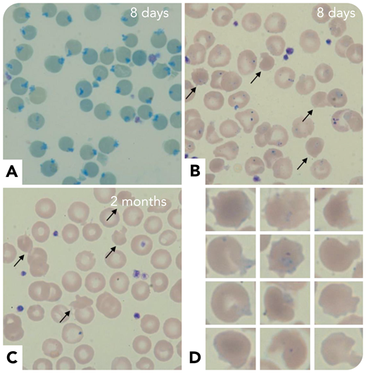 A newborn presented at 8 days of life with neonatal jaundice, hemoglobin of 10.9 g/dL, and mean corpuscular volume of 102 fL. An abnormal reticulocyte scattergram led to the preparation of a blood smear after cresyl blue staining. All erythrocytes exhibited peripheric blue inclusions corresponding to Heinz bodies (panel A; ×50 objective; original magnification ×500) with reticulocyte count of 87 × 109/L. May-Grünwald-Giemsa staining showed anisopoïkilocytosis, intraerythrocytic inclusions including Pappenheimer bodies, and 5% to 10% hyperdense cells (panel B, arrows; ×50 objective; original magnification ×500). Three days later, hemoglobin decreased to 6.3 g/dL, with a reticulocyte count of 176 × 109/L. The result of a direct antiglobulin test was negative. Extensive enzyme assays, ektacytometry, hemoglobin electrophoresis, and molecular analysis of α and β-genes were normal. Three erythrocyte transfusions were needed before clinicobiological improvement. At 2 months, Heinz bodies were no longer visible, but 2% to 3% hyperdense and irregular erythrocytes (pyknocytes) could still be seen (panels C-D; ×50 objective; original magnification ×500). The diagnosis of infantile pyknocytosis was finally retained retrospectively, after hemoglobin improvement and disappearance of pyknocytes.