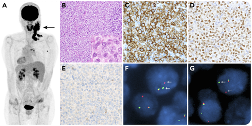 A 69-year-old woman presented with cervical, mediastinal, and axillary lymphadenopathy (panel A, arrow). An excised specimen showed diffuse involvement by atypical large lymphoid cells, occasionally with kidney or horseshoe-like nuclei (panel B, hematoxylin and eosin, objective ×10, inset, objective ×40). These cells were positive for CD2, CD3, CD30 (panel C, objective ×40), and p63 (panel D, objective ×40), and negative for CD4, CD5, CD7, CD8, CD15, CD20, ALK, TIA-1 (panel E, objective ×40), and granzyme B. Diagnosis of anaplastic large cell lymphoma (ALCL), ALK-negative, was made. Surprisingly, fluorescence in situ hybridization identified the rearrangements of both DUSP22 (panel F) and TP63 (panel G). The patient achieved complete remission after cyclophosphamide, vincristine, doxorubicin, and prednisone therapy, and is without recurrence 7 months after diagnosis.