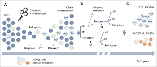 Clonal hematopoiesis (CH) in AA. (A) A schematic diagram depicting the relationship between the autoimmune pathogenesis of AA and the emergence of CH. The autoimmune attack (lightning symbol) on HSPCs (gray circles) by cytotoxic T lymphocytes leads to bone marrow (BM) aplasia. After the patients achieve hematopoietic recovery following immunosuppressive therapy (IST), they may develop the clonal expansion of cells bearing somatic mutations (circles of different colors) due to a relative growth or survival advantage conferred by somatic mutations. (B) A schematic diagram illustrating various treatment outcomes that may affect clonal evolution, including achievement of complete remission (CR), partial remission (PR), or having refractory disease following IST. Approximately one-third of the patients will experience a relapse. Some of the patients with relapsed and refractory disease may be salvaged by a second round of IST. (C) With long-term follow-up, 15% to 20% of patients will acquire additional genetic alterations (dark orange circles) and will progress to secondary myelodysplastic syndrome (MDS)/acute myeloid leukemia (AML), whereas 20% to 25% of patients will develop hemolytic paroxysmal nocturnal hemoglobinuria (PNH) over the course of their disease (caused by PIGA mutation).