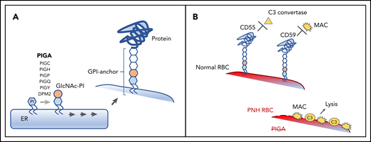 Pathogenesis of PNH. (A) A schematic diagram depicting the normal biosynthesis of glycophosphatidylinositol (GPI)-anchored proteins. The first enzymatic step in GPI-anchor biosynthesis, the addition of N-acetylglucosamine (GIcNAc, tan circle) to phosphatidylinositol (PI, blue hexagon), is catalyzed on the cytoplasmic side of the endoplasmic reticulum (ER) by a multisubunit complex that requires PIGA. Subsequent enzymatic steps (denoted by multiple arrows) add sugar moieties (white hexagons) to form the GPI anchor, which is then added to the precursor proteins on the luminal side of the ER. (B) The clinical symptoms of PNH are characterized by complement-mediated intravascular hemolysis, which occurs due to the deficiency of 2 GPI-anchored complement-regulatory proteins, CD55 and CD59. Under normal conditions, CD55 and CD59 on the surface of the red blood cell (RBC) inhibit C3 convertase and the membrane attack complex (MAC), respectively, protecting RBCs from complement-mediated lysis. In PNH, the defect in the PIGA gene leads to the absence of all GPI-anchored proteins, including CD55 and CD59, making the PNH RBC susceptible to complement activation and lysis.