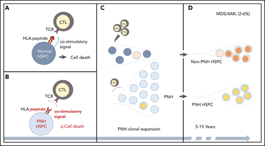 CH in PNH. (A-B) A schematic of the relationship between immune-mediated BMF and the development of PNH. (A) In immune-mediated BMF, such as AA, HSPCs (dark gray circles) undergo immune-mediated attack by cytotoxic T lymphocytes (CTLs), which recognize AA autoantigen presented in the context of an HLA molecule (red lines, HLA:peptide) via a T-cell receptor (TCR). Effective CTL activation requires the presence of a costimulatory signal (blue line). (B) PNH HSPCs (light gray circles) are believed to evade autoimmune T-cell recognition by 1 or more mechanisms, which include lack of a GPI-anchored autoantigen, lack of a costimulatory interaction that may involve GPI-anchored proteins, or relative resistance to T-cell–mediated cell death. (C) The evasion of the CTL-mediated immune attack leads to clonal expansion by the PNH HSPCs. Ongoing autoimmune selective pressure may lead to the emergence of additional somatic mutations (depicted by colored circles) both in the ancestral, previously normal HSPCs and in the PNH HSPCs. (D) With long-term follow-up, stepwise accumulation of additional genetic events, either in the ancestral HSPCs or in the PNH clone, can lead to secondary MDS-AML in 3% to 6% of PNH patients.