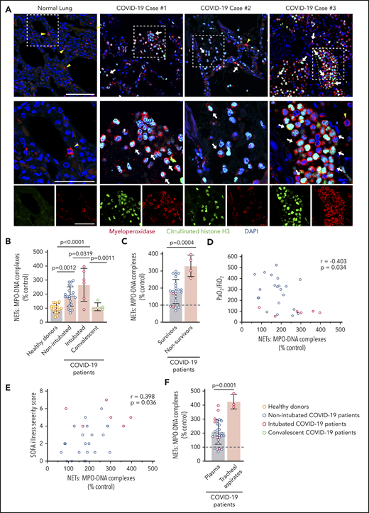 Increased plasma NETs correlate with increased COVID-19 severity. (A) We stained for neutrophils and NETs, using immunofluorescence, in lung tissue obtained at autopsy from COVID-19 patients (n = 3). Commercially available normal lung tissue was stained as a negative control. Neutrophils express MPO (red), and early-stage NET-forming neutrophils also express citrullinated histone H3 (green). DAPI serves as a nuclear DNA counterstain (blue). Cyan fluorescence represents the colocalization of citrullinated histone H3 with DNA. The yellow arrowheads point to neutrophils not making NETs, and the white arrows point to neutrophils making NETs. The dashed line highlights a thrombus in the microvasculature (top right panel). Scale bar, 100 μm. Higher-magnification images of the boxed areas in the top row (middle row) are shown along with single-channel images (bottom row); scale bars, 50 μm. (B-F) We used MPO-DNA ELISA to assess NETs in plasma and tracheal aspirate samples from patients in our COVID-19 prospective cohort and in age- and sex-matched healthy donors; each colored dot represents an individual participant. (B) We compared plasma NET levels across all groups: healthy adult donors (n = 17), adults hospitalized with COVID-19 but not intubated for ARDS (n = 22), adults intubated for COVID-19 ARDS (n = 6), and adults recovered from COVID-19 (n = 5). The y-axis depicts plasma NETs expressed as a percentage of healthy adult controls ± SD, arbitrarily set at 100%. (C) We compared plasma NET levels in 2 groups of COVID-19 hospitalized patients: survivors (n = 24) vs nonsurvivors (n = 4). The y-axis depicts plasma NETs expressed as a percentage of healthy adult donors ± SD, arbitrarily set at 100% (dashed line). (D) We correlated plasma NET levels with the Pao2/FiO2 ratio measure of respiratory failure for all hospitalized COVID-19 patients (n = 28). (E) We correlated plasma NET levels with the SOFA Illness Severity Scores for all hospitalized COVID-19 patients (n = 28). (F) We compared plasma NET levels in adult COVID-19 patients (n = 28) with NET levels quantified in the available tracheal aspirate samples of intubated COVID-19 patients (n = 3). The y-axis depicts NET levels expressed as a percentage of healthy adult donors ± SD, arbitrarily set at 100% (dashed line). One-way ANOVA with Tukey’s multiple-comparisons post hoc testing (B-C), Spearman’s rank-correlation test (D-E), Student t test (F).