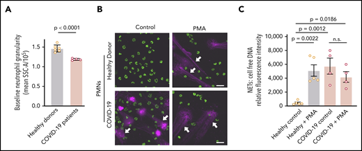 COVID-19 PMNs demonstrate increased activation and NETs at baseline and fail to respond to PMA with increased NET formation. (A) We assessed granularity using flow cytometry in PMNs isolated from healthy donors (n = 6) and COVID-19 patients (n = 4) as a measure of baseline PMN activation. (B-C) We assessed NETs in PMNs isolated from healthy donors (n = 5) and COVID-19 patients (n = 4), with and without PMA stimulation (20 nM; 2 hours), using confocal microscopy and cell-free DNA quantitation. (B) Representative images show NETs (magenta; white arrows) and nuclear DNA (green). Scale bars, 20 μm. (C) We quantified NETs using a fluorescence-based cell-free DNA assay as described in Patients and methods. The y-axis depicts NETs shown as relative cell-free DNA fluorescence ± SEM. Student t test (A), 1-way ANOVA with Tukey’s multiple-comparisons post hoc test (C). n.s., not significant.