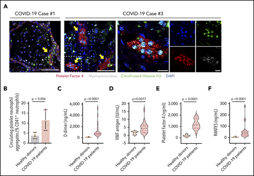 NETs associate with microthrombi formation and platelet deposition in COVID-19 patients. (A) We stained for NETs and platelets using immunofluorescence in COVID-19 lung tissue obtained from autopsy cases #1 and #3. Early-stage NET-forming neutrophils (MPO, white) express citrullinated histone H3 (green). Microthrombi stained for early-stage NET-forming neutrophils and platelets (PF4; red). DAPI served as a nuclear DNA counterstain (blue). Scale bars, 100 μm (low-magnification, 2 leftmost images). For case #3, higher-magnification images are presented along with single-channel images. Scale bars, 20 μm. Yellow arrows point to thrombi with early-stage NET-forming neutrophils. Colocalized PF4 and early stage NET-forming neutrophils were not present in the analyzed lung sample from case #2. (B) We used flow cytometry to quantify platelet-neutrophil aggregates in whole blood from COVID-19 patients (n = 5) and healthy donors (n = 6). We used ELISA to quantify plasma levels of D-dimer (C), VWF antigen (D), PF4 (E), and RANTES (F) in available plasma from 18 to 22 COVID-19 patients and 5 to 7 healthy donors. Student t test (B), Mann-Whitney or Student t test, depending on the normality of distribution (C-F).