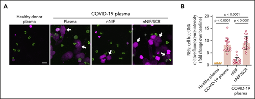 nNIF blocks NETs induced by soluble factors in plasma from COVID-19 patients. (A) We used confocal microscopy to assess NET formation qualitatively. We isolated PMNs from healthy adults (n = 4) and used those for experiments testing 16 different available COVID-19 patient plasma samples for NET inductive capacity. We used plasma from age- and sex-matched healthy donors as a control (n = 10). We incubated PMNs with control plasma or COVID-19 patient plasma and assessed for NET formation after a 2-hour incubation. PMNs were preincubated for 1 hour with nNIF (1 nM) or its inactive scrambled peptide control (SCR; 1 nM). Representative images from each experimental arm show NETs (magenta; white arrows) and nuclear DNA (green). Scale bar, 20 μm. (B) We used a high throughput cell-free DNA fluorescence assay to quantify NET formation in the PMNs treated in (A). The y-axis depicts NETs measured as fold change over baseline relative fluorescence units ± SEM. The PMNs treated with control healthy donor plasma serve as the baseline PMN NET level, arbitrarily set at 1. The P values were determined using 1-way ANOVA with Tukey’s multiple-comparisons post hoc testing.