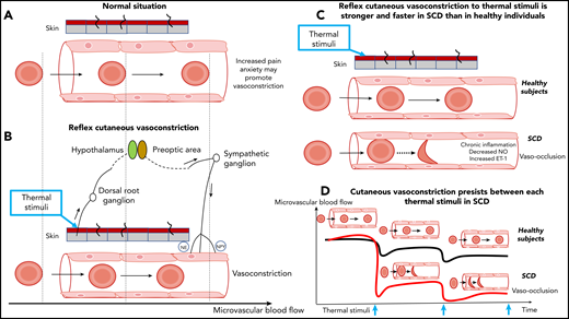 Reflex vasoconstriction to thermal stimuli in healthy individuals and patients with SCD. (A) Cutaneous vessel and flowing red blood cells at baseline in a healthy individual. (B) Normal reflex vasoconstriction to thermal stimuli applied to the skin and flowing red blood cells in a healthy individual. The x-axis at the bottom of the figure indicates red blood cell velocity. The release of norepinephrine (NE) and neuropeptide Y (NPY) causes vasoconstriction. The vertical dashed lines crossing panels A and B are arbitrary time points to show the impact of vasoconstriction on the red blood cell transit time. (C) Reflex vasoconstriction to thermal stimuli is faster and stronger in patients with SCD compared with healthy volunteers. Additional factors, such as inflammation, nitric oxide (NO) bioavailability, and endothelin-1 (ET-1) levels could modulate the level of this vasoconstrictive response. (D) The repetition of thermal stimuli results in progressive and increasing vasoconstriction in SCD patients whereas blood flow of healthy volunteers partially recovers. Vasoconstriction prolongs the transit time of red blood cells and increases the risk of vaso-occlusion. Blue arrows indicate thermal stimuli.