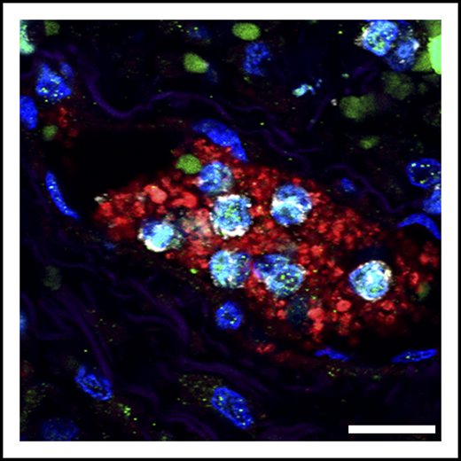 Detail of neutrophils (gray) bearing markers of NETs (citrullinated histone; green), trapped in a platelet-rich clot (red). These microthrombi are found in the lungs of patients with severe COVID-19. Scale bar, 20 μm. See Figure 3A in the article by Middleton et al that begins on page 1169.
