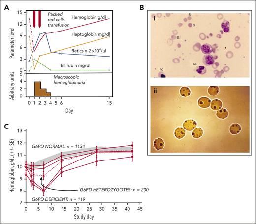 Clinical course of AHA in G6PD-deficient persons. (A) Attack of severe favism in a 5-year-old Sardinian boy (courtesy of Gianfranco Meloni). (B) Blood smears on day 1 of patients with favism: (i) May-Grünwald-Giemsa staining, original magnification ×1000; (ii) Heinz body supravital staining, original magnification ×1000. (C) Time course of Hb levels in a large cohort of children with P falciparum malaria who received antimalarial treatment with a drug combination (Lapdap) containing dapsone. Eleven percent of G6PD-deficient hemizygous boys and 0.5% of heterozygous girls required blood transfusion. All of these children were in clinical trials under appropriate medical supervision; there were no deaths (there might have been outside of clinical trials). B, bite cell; nc, nucleated red cell; S, spherocyte. Modified from (A) Luzzatto and Arese,32 (B) Luzzatto and Poggi,63 and (C) Pamba et al33 with permission.