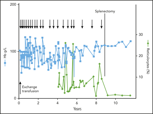 Clinical course of a patient with CNSHA. The patient presented with severe NNJ requiring exchange blood transfusion; he then had moderate to severe anemia requiring frequent blood tranfusions (arrows at the top). At 9 years of age, he was splenectomized, whereupon he became transfusion-independent. Note the persistent reticulocytosis, that remitted after splenectomy. The underlying unique variant was G6PD Harilaou (class I: F216L). Reproduced from Luzzatto and Poggi63 with permission.