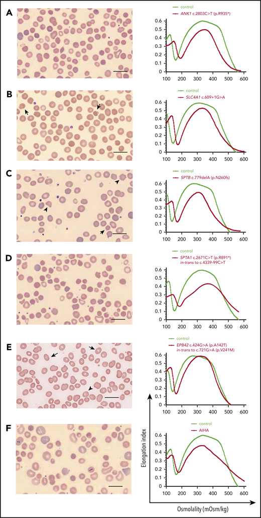 HS. Examples of red cell morphology in HS due to different gene mutations and associated osmotic gradient ektacytometry curves. Spherocytes (ie, RBCs with no or decreased central pallor) predominate, but additional RBC morphology characteristics may provide hints to the gene/protein defect causing HS, as Palek and Sahr31 and Eber and Lux13 have described very astutely in the past. (A-E, left) Blood smear of a patient with AD ANK1-HS showing anisocytosis (A). Occasional mushroom-shaped red cells (arrows) are characteristic of HS due to deficiency of band 3 (SLC4A1) (B). Acanthocytes (arrowheads) and echinocytes (arrow) are noted along with spherocytes in SPTB-associated HS (C). Blood smear of a not-recently transfused patient with AR SPTA1-HS demonstrates remarkable anisocytosis and poikilocytosis with contracted dense cells (D). Ovalocytes (arrows) and few ovalostomatocytes (arrowheads) are noted in AR EPB42-HS (E). Nevertheless, the above described changes in RBC morphology are not always specific for the gene affected in HS.102 Scale bars, 14 µm; Wright-Giemsa stain. (A-E, right) The ektacytometry curve in HS is characterized by increased Omin, which corresponds to the increased osmotic fragility of the spherocytes. In almost all cases, decreased maximum deformability indicated by low EImax is also noted, as well as decreased Ohyp. The decrease in EImax tends to correlate with the degree of hemolysis and severity of anemia. (F) Important for differential diagnosis is that not all spherocytosis is hereditary. Autoimmune hemolytic anemia due to warm-reacting immunoglobulin G causes RBC membrane loss and acquired spherocytosis, with erythrocyte morphology and ektacytometry resembling HS. It is advisable to initiate the workup by first considering the possibility of an immune-mediated cause in every hemolytic anemia, since this radically alters management. In addition, blood smear and ektacytometry in congenital dyserythropoietic anemia type II also resemble HS; higher MCV, suboptimal reticulocytosis, and ferritin values disproportionally high for the number of transfusions will provide a clue to this possibility if bone marrow studies have not yet been performed. AIHA, autoimmune hemolytic anemia.