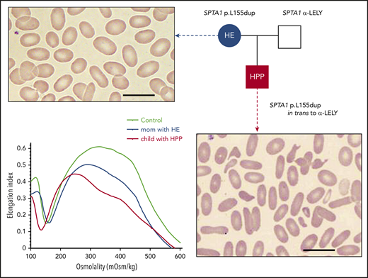 HE and HPP. The most common form of HPP, diagnosed in infants with neonatal hyperbilirubinemia, is due to an SPTA1 HE-causing mutation in trans to the intronic SPTA1 variant c.6531-12C>T known as αLELY (low-expression LYon). Familial studies at the time reveal that 1 parent carries the SPTA1 HE-causing mutation and has elliptocytosis (smear characterized by elliptically shaped red blood cells), while the other parent carries αLELY with a normal erythrocyte phenotype. The blood smear in HPP is characterized by marked anisocytosis and poikilocytosis with bizarre microcytes and fragmented cells along with elliptocytes (scale bars, 14 µm; Wright-Giemsa stain). HPP RBCs were found early on to have increased thermal sensitivity; this is maybe the source of the name pyro (coming from the Greek word “πυρ” meaning fire)-poikilocytosis. Another possibility for the origin of the term is that the cells resemble the morphology of the blood smear in patients with the microangiopathic hemolytic anemia of patients with extensive burns.