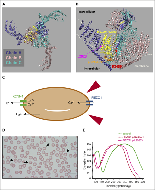 HX due to heterozygous PIEZO1 mutation. Human PIEZO1 is a 2521 amino acid (287 kDa) protein with ∼38 transmembrane helices. Cryoelectron microscopy studies of the highly homologous mouse Piezo1 reveal that PIEZO1 trimers form an elegant 3-bladed propeller structure with a curved transmembrane region creating an inverted membrane dome and a central ion pore formed by the C-terminal domains of the subunits, in which most of the disease-causing mutations are located.103-106 This unique structure of PIEZO1 senses changes in membrane tension to alter gating of the ion channel.106,107 (A) Top view of the homotrimeric PIEZO1 channel showing its 3-bladed, propeller-like architecture (from the extracellular space looking down through the central pore). The 3 subunits of the trimer are color coded. (B) Side view of the homotrimeric PIEZO1 channel showing the curved transmembrane region, which creates a membrane dome.106,107 The position of the membrane is roughly indicated with white dotted lines. Two of the mutation “hot spot” areas described by Picard et al56 are highlighted in chain A (dark blue); the sequence p.R2456-P2510 in the pore domain (coded within exon 51) is colored orange, and one of the most common HX mutations in this region (p.R2456) is labeled in red; the sequence p.S1994-V2201 (coded within exons 42-45) is colored yellow, and one of the mutations in this area (p.L2023V) is indicated in magenta. A third hot-spot region for mutations is located N-terminally in exons 14 to 18; the structure of this area has not yet been modeled. Patients demonstrating a more severe phenotype are more likely to have mutations in the PIEZO1 pore domain.56 Images created using UCSF Chimera,108 with the Protein Data Bank structure model 3JAC. (C) Sketch of interaction between PIEZO1 and KCNN4 as RBCs travel through the vasculature. In narrow capillaries and sinusoids, mechanical stress (represented by the red arrowheads) results in activation of PIEZO1 and Ca2+ entry. Increased intracellular Ca2+ leads to activation of KCNN4 (a calcium ion binds to each of the 4 calmodulin molecules tightly bound to the cytoplasmic domains of the 4 KCNN4 subunits),109 and K+ efflux ensues. Subsequent water loss results in a temporary decrease in cell volume and facilitates passage.57-59 (D) Blood smear from a patient heterozygous for p.R2456H with macrocytosis (MCV 96 fL) showing occasional stomatocytes (arrows), target cells (arrowheads), and dense cells (thin arrows). (E) Osmotic gradient ektacytometry showing the typical HX curve with left shift due to decreased Omin and Ohyp, indicating RBC dehydration. Ekatacytometry profiles are shown for 2 patients with HX due to PIEZO1 p.R2456H and p.L2023V.