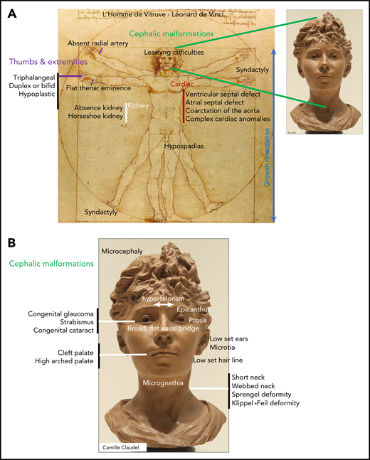 Congenital malformations in DBA. (A) Range of congenital anomalies observed in Diamond-Blackfan anemia. (B) Cephalic area malformations in detail.